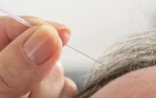 does medicare cover acupuncture treatments