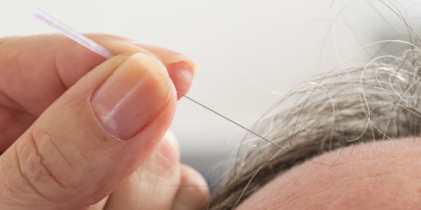 does medicare cover acupuncture treatments